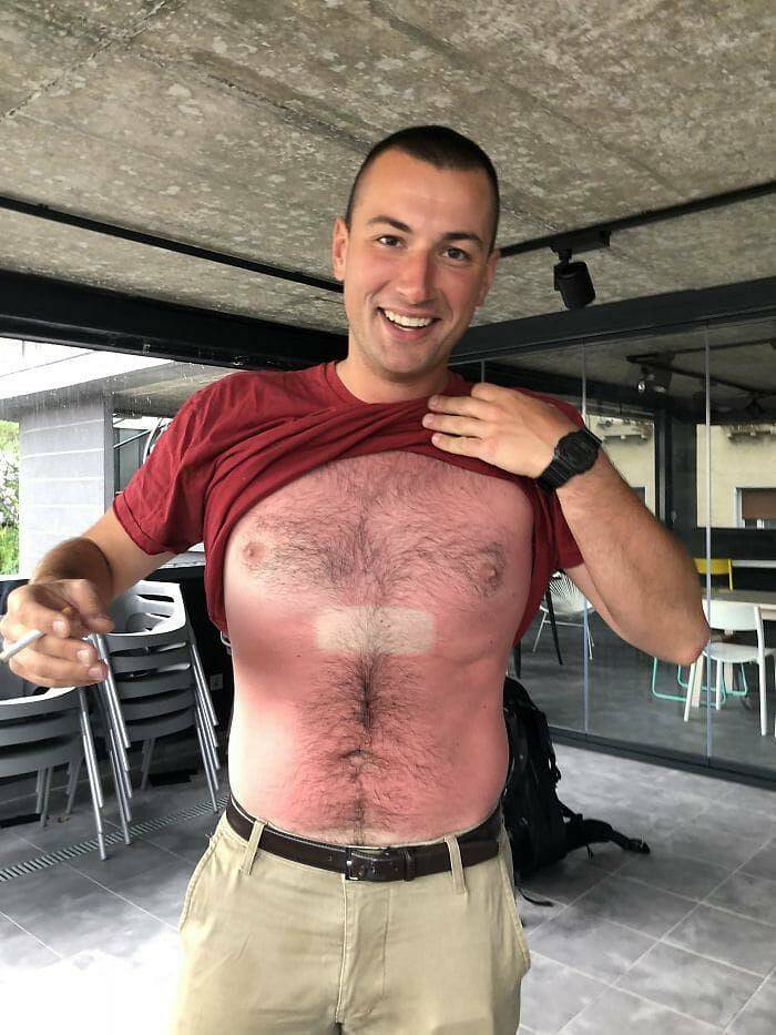 When Sunbathing Goes Wrong…