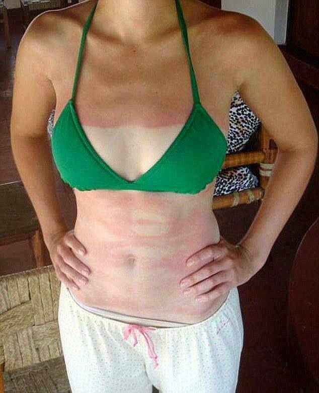 When Sunbathing Goes Wrong…