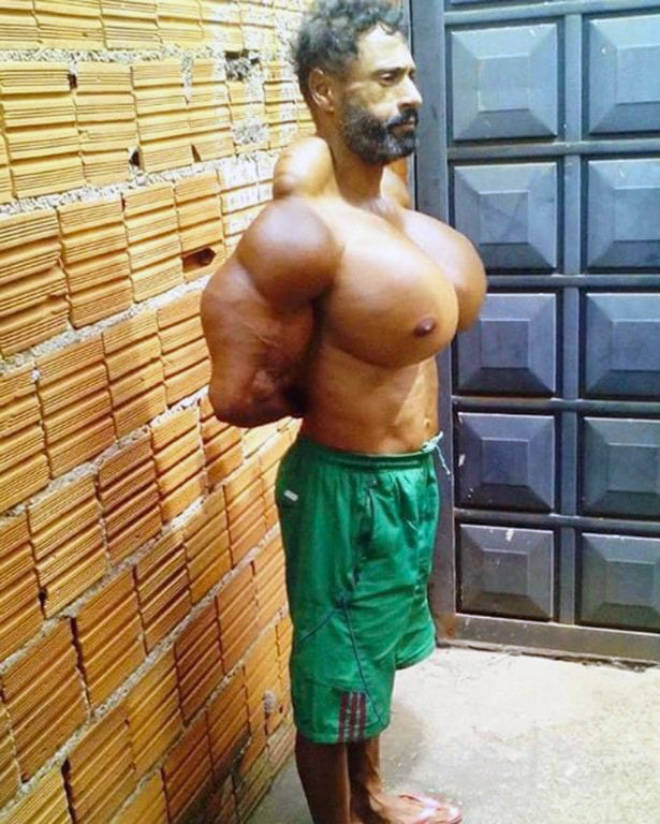 Synthol Does NOT Look Good, Guys…