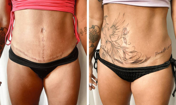 Artist Saves People’s Scars By Tattooing Over Them