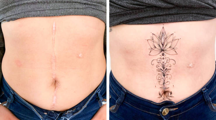 Artist Saves People’s Scars By Tattooing Over Them