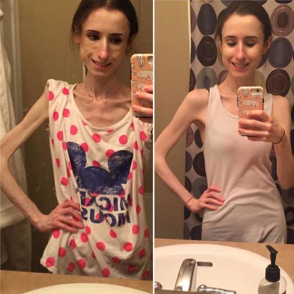 Anorexia Is Not The Final Verdict!