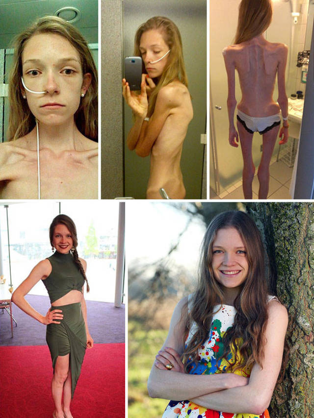 Anorexia Is Not The Final Verdict!
