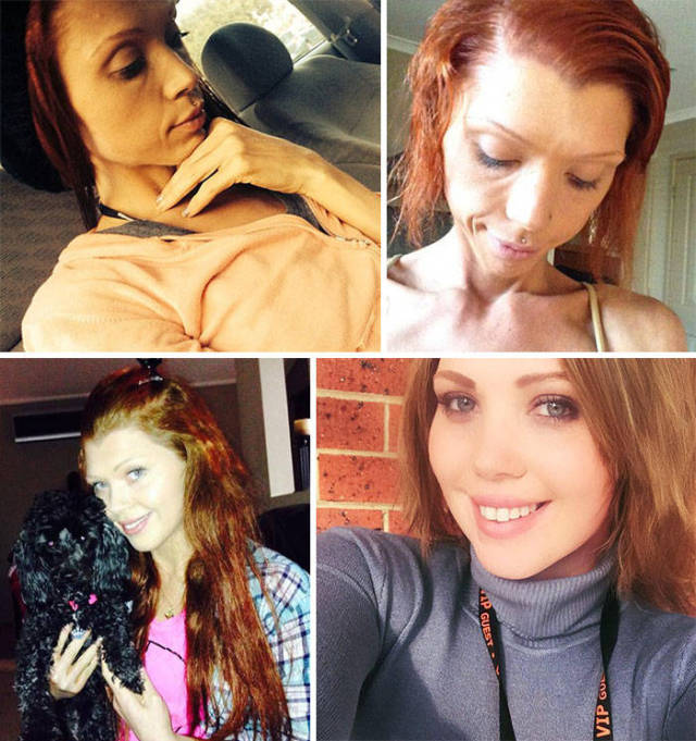 Anorexia Is Not The Final Verdict!