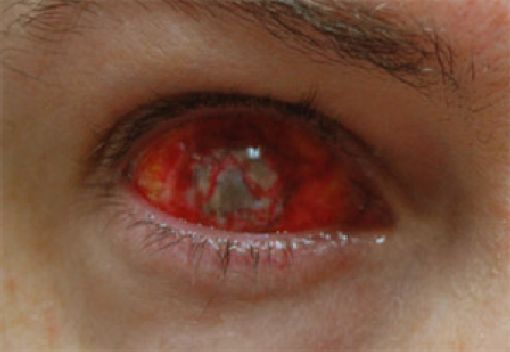 Eerie Eyeball Covers