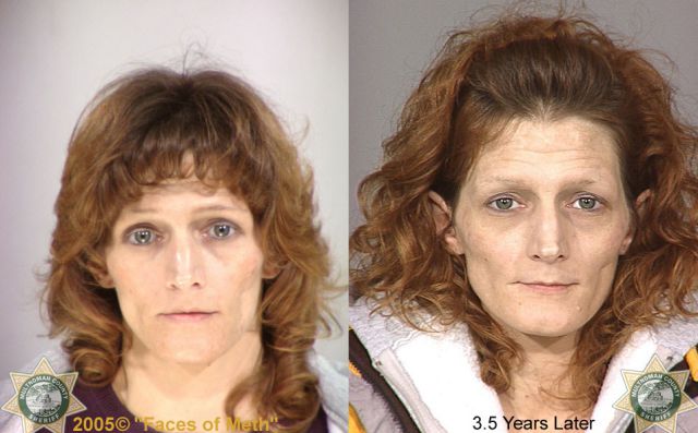 Meth Addicts: Before and After