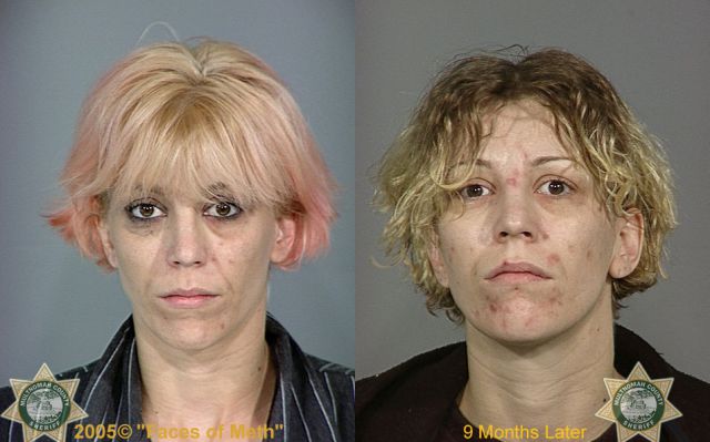 Meth Addicts: Before and After