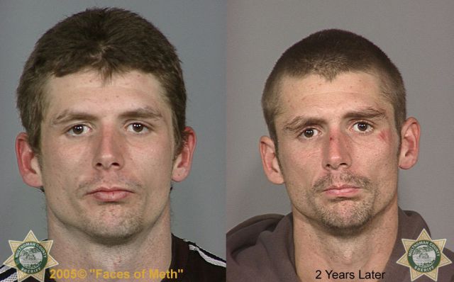 Meth Addicts: Before and After