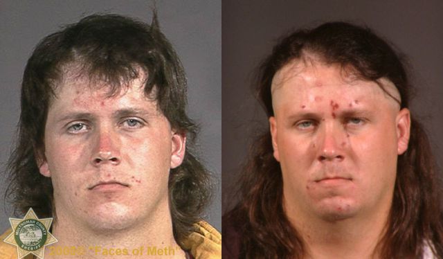 Meth Addicts: Before and After