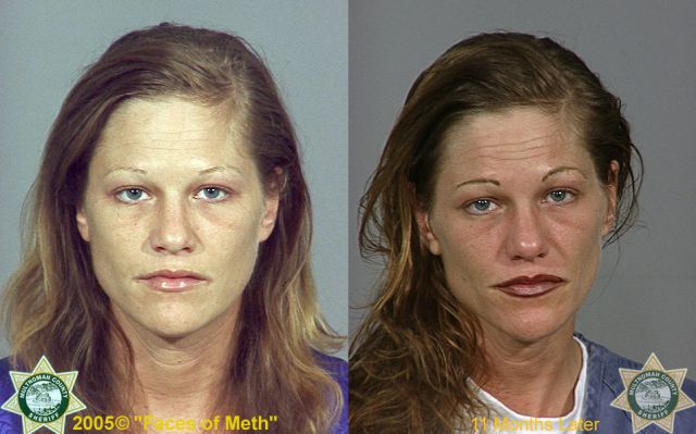 Meth Addicts: Before and After