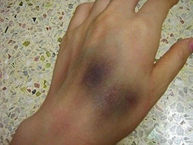 Are These Horrible Hand Wounds Real?