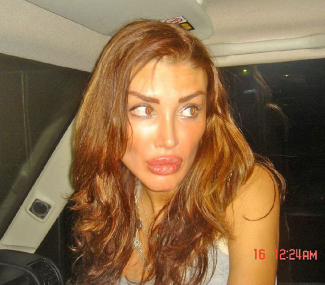 Ladies With Silicone Overdose