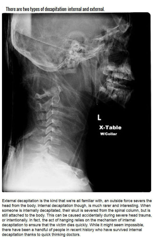 The Factual and Scientific History of Decapitation